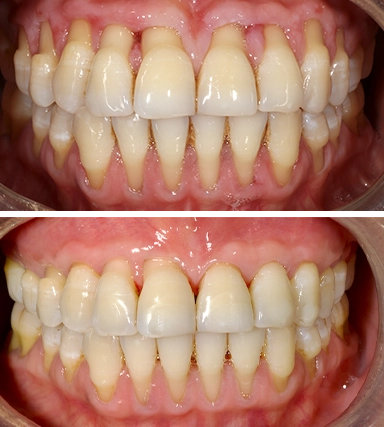 GumRecession01-SouthernHighlandsDental.webp
