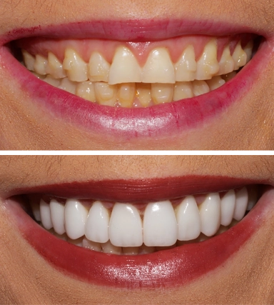 Veneers08-SouthernHighlandsDental.webp