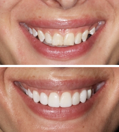 Veneers01-SouthernHighlandsDental.webp