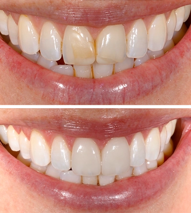 Veneers07-SouthernHighlandsDental.webp