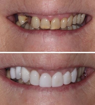 Veneers05-SouthernHighlandsDental.webp