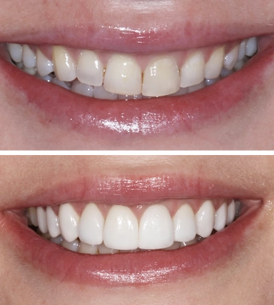 Veneers02-SouthernHighlandsDental.webp