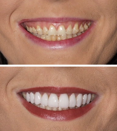 Veneers01-SouthernHighlandsDental.webp
