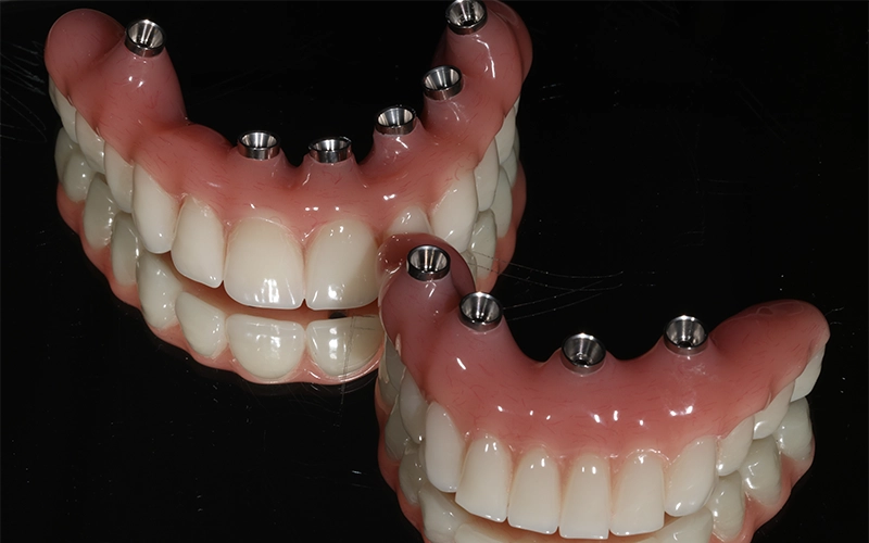 ToothImplants03-SouthernHighlandsDental.webp