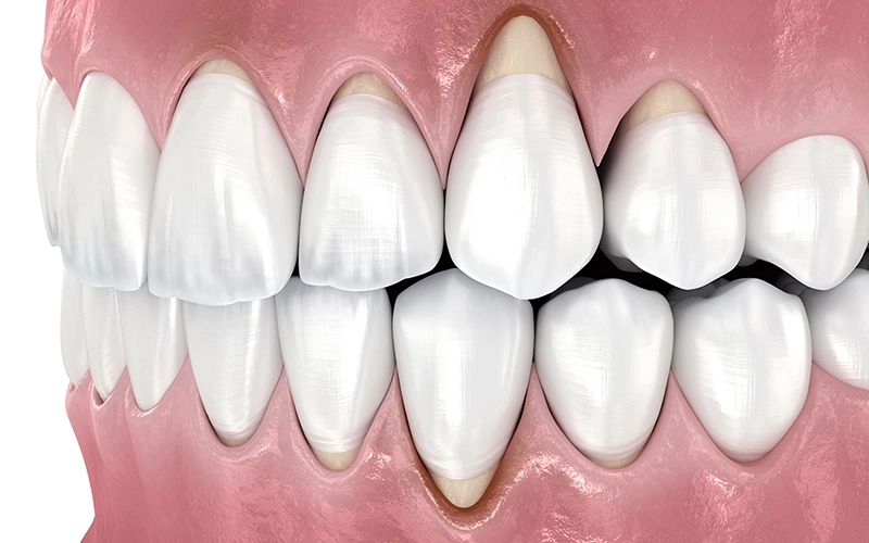 GumRecession-SouthernHighlandsDental.webp
