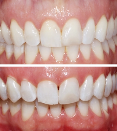 ToothWhitening-SouthernHighlandsDental.webp