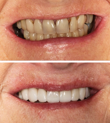 Veneers03-SouthernHighlandsDental.webp
