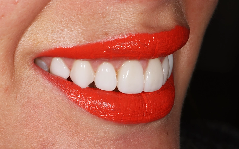 Veneers-SouthernHighlandsDental.webp