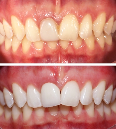 ToothWhitening02-SouthernHighlandsDental.webp